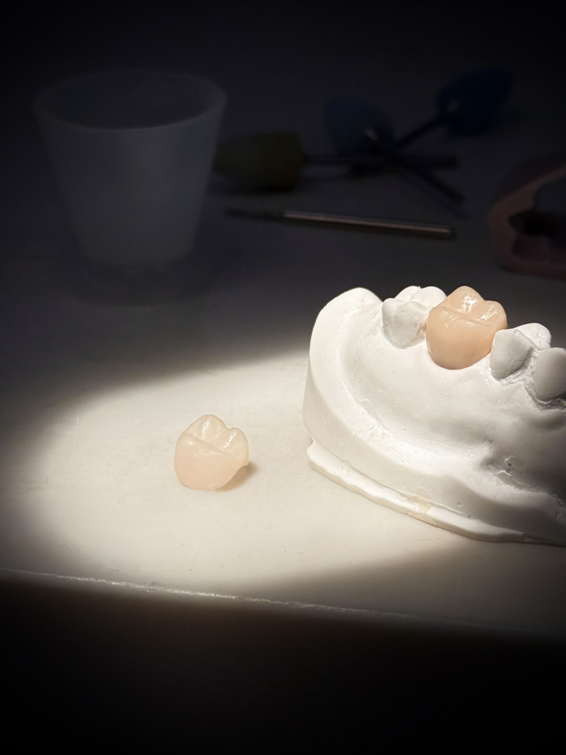 Porcelain dental crown on a plaster cast